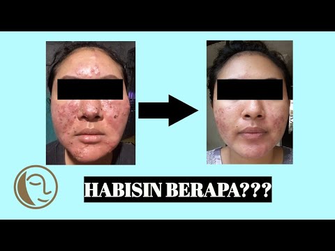 Laser Khusus Jerawat | Laser Toning Acne Natasha Skincare Sidoarjo. 