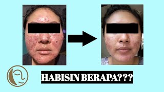 CARA MENGHILANGKAN BEKAS JERAWAT SECARA CEPAT | TREATMENT DIAMOND PEEL DI NATASHA SKINCARE