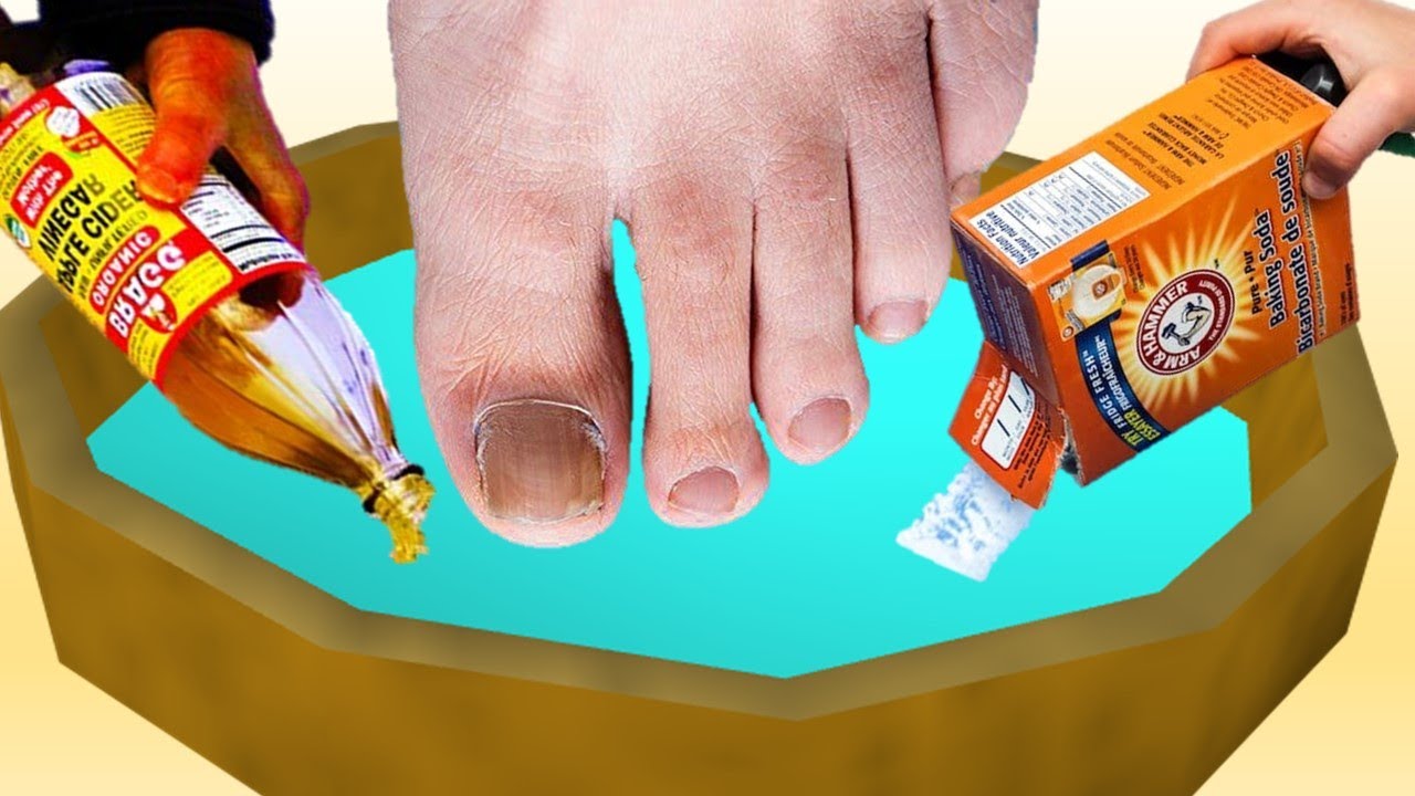 Really Bad Toenail Fungus: [Causes, Home Remedies & Best Treatment!]