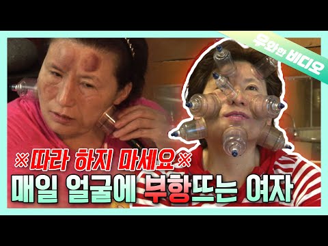 매일 얼굴에 부항 뜨는 여자┃No One Forced Her, But She <strong>Does</strong> Cupping On Her <strong>Face</strong> Every Day