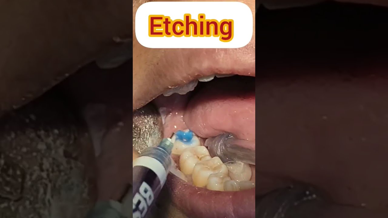 Amazing Teeth Cavity Filling Process Shorts Ytshorts Youtubeshorts Hindi Trending Viral