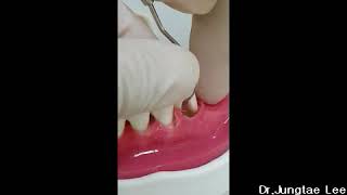 Periodontal instruments: Nabers probe
