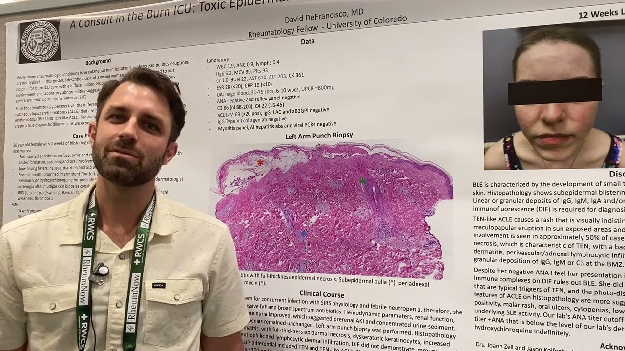 A Consult in the Burn ICU: Toxic Epiderman Necrolysis vs Acute Cutaneous Lupus Erythematosus