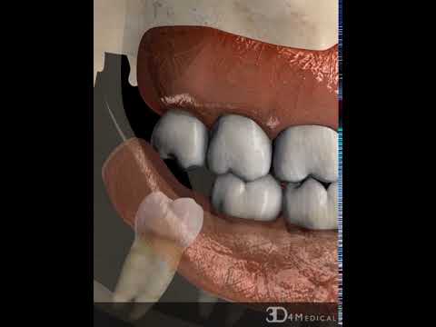 Pericoronitis