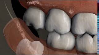 Pericoronitis