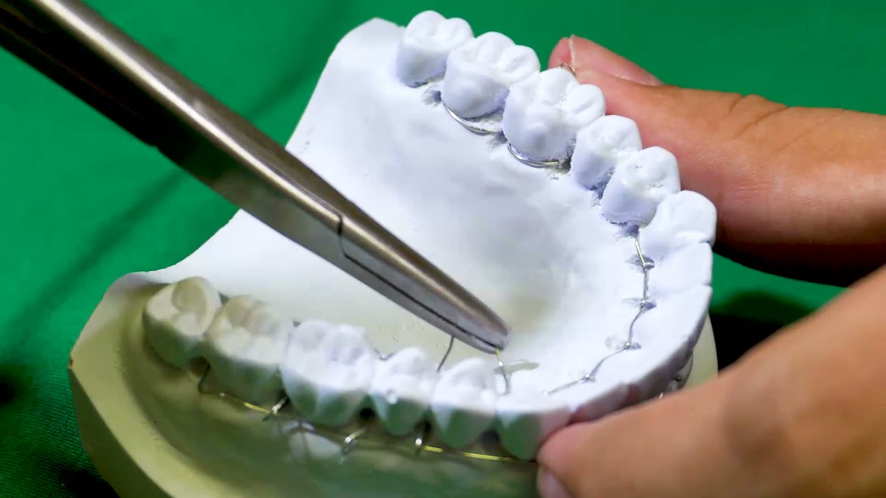 FIKSASI DENTOALVEOLAR: STOUTS