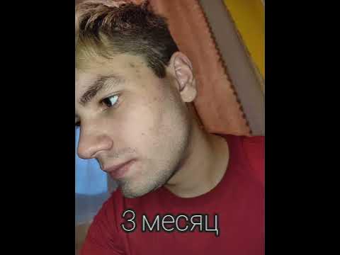 Миноксидил. Результат за 3 месяца. До и После. Minoxidil Kirkland 5% ...