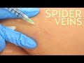 The Best Spider Veins Treatment | The SASS with Susan and Sharzad