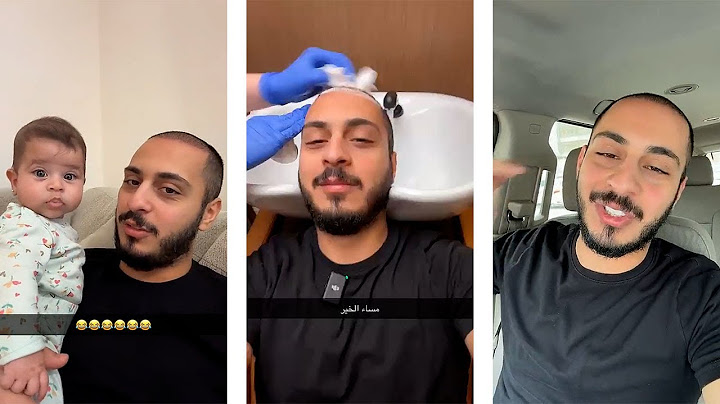 تحول صادم! 😳 شوفوا كيف صار شكل وليد بعد الزراعة!