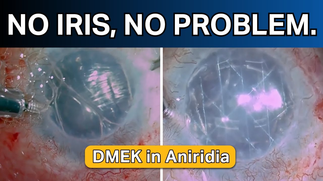 No iris, no problem. DMEK in aniridia. - YouTube