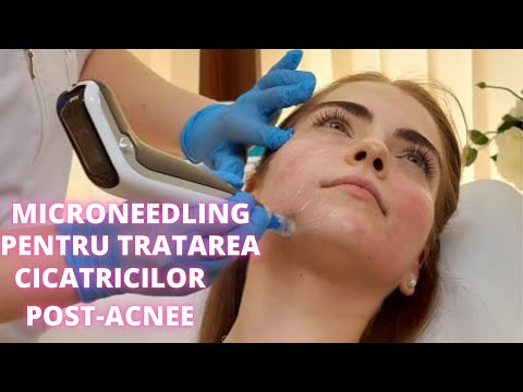 Microneedling (Dermapen) pentru tratarea cicatricilor post-acnee | DermaBeauty Clinique