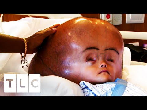 Video: The Boy, Who Was Born With A Piece Of His Brain Out, Celebrated His 10th Birthday - Alternative View