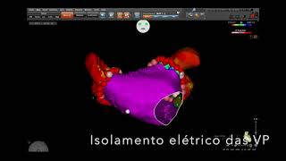 Atrial Fibrillation Catheter Ablation