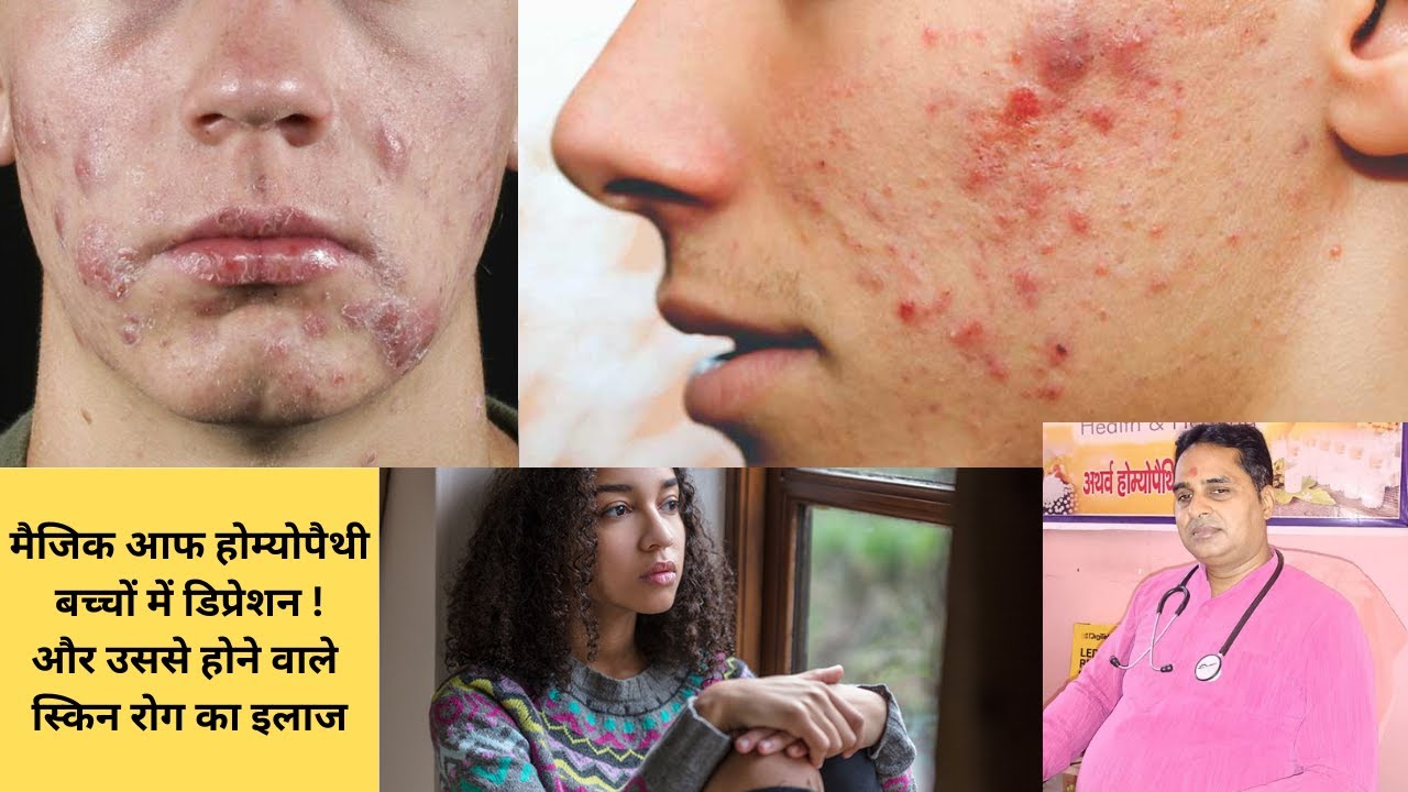 Magic of Homeopathy Face Pimples Child Depression Homeopathic