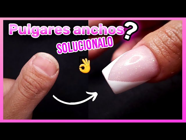 Como Hacer UÑAS en dedos Pulgares ANCHOS 👍| BRAQUIDACTILIA - thptnganamst.edu.vn