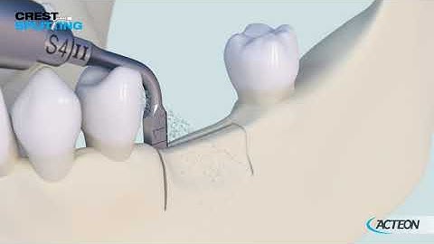 Surgery Crest Splitting 3D protocol