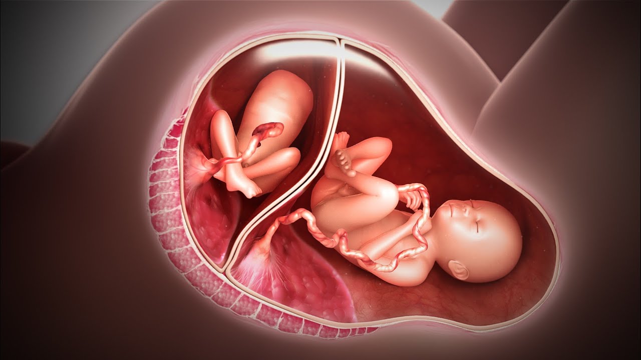 Twin Reversed Arterial Perfusion TRAP; monochorionic twin pregnancies, twins share a single placenta