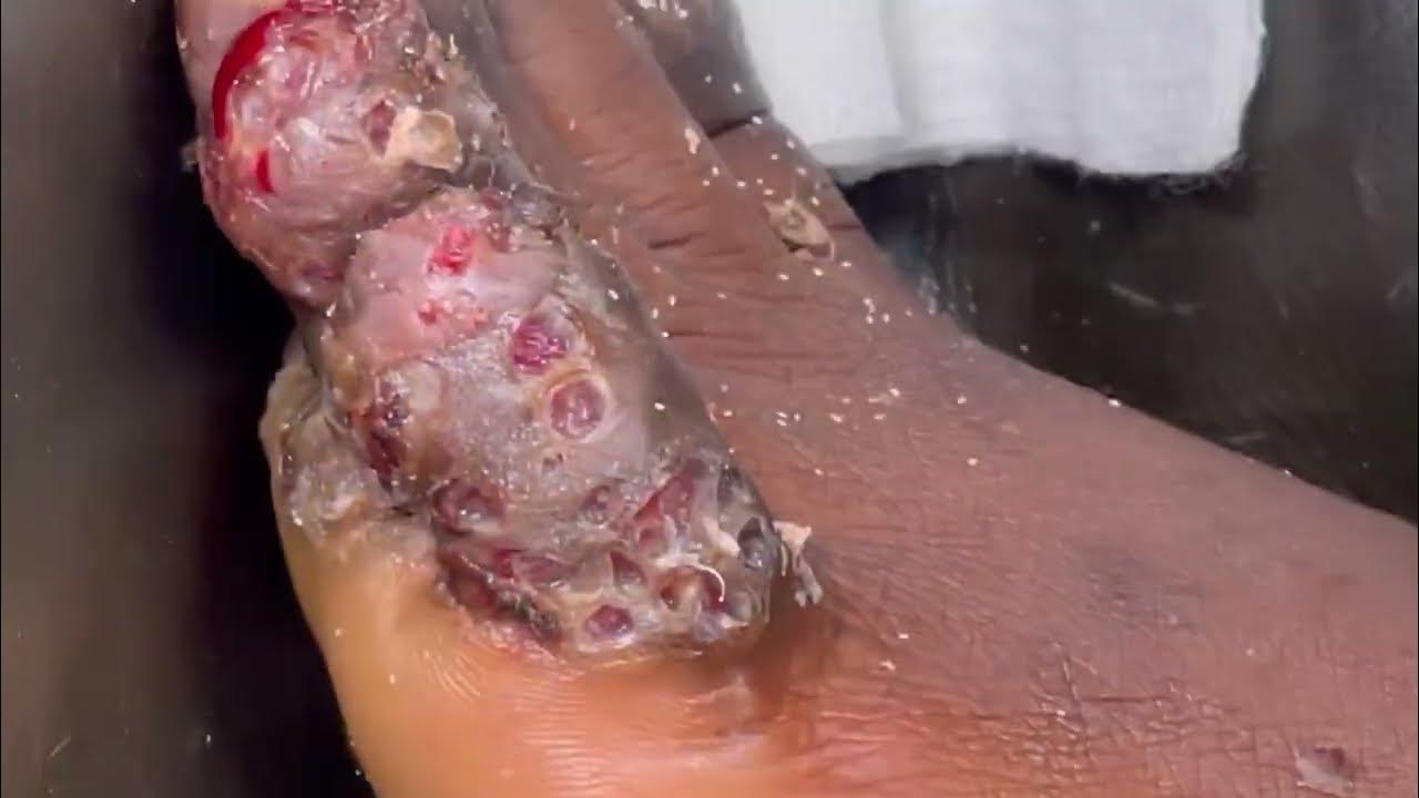 John Nabuule's left foot; the worst attack ever final jigger digging