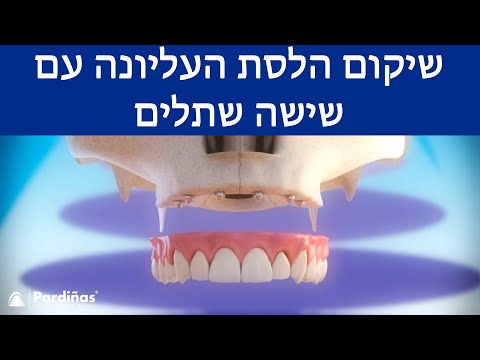 © שיקום הלסת העליונה עם שישה שתלים