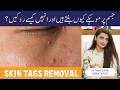 SKIN TAGS Causes Solution Moko Ka Ilaj Kaise Karen Skin Tags Removal Skin Tag Banne Ki Wajah