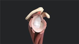 Bone Block Cerclage