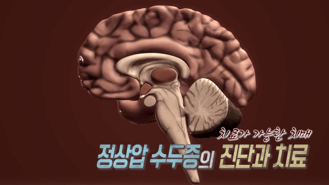 [TV메디컬 약손]20220920(650회)치료가능한 치매_정상압수두증의 진단과 치료_신경과 전문의 강경훈교수, 신경외과 전문의 박기수교수