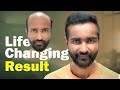 Lifechanging transformation 5000 grafts hair transplant restores grade 6 baldness in just 7 months