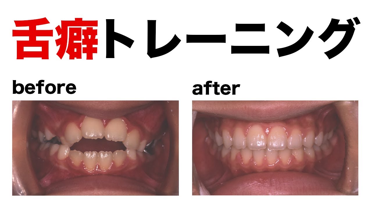【舌癖】たったこれだけの習慣が