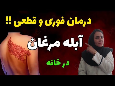 درمان فوری و قطعی آبله مرغان به روش خانگی آیا آبله مرغان واکسن دارد از کجا زونا میگیری