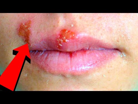 Video: Herpes Zoster səbəbiylə sinir ağrısını necə müalicə etmək olar (şəkillərlə birlikdə)