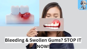 Bleeding Gums: Bleeding Gums: Swollen Gums? Here’s What You Need to Do Right Now!