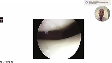 Knee Arthroscopy: A Basic Guide 👨‍⚕️