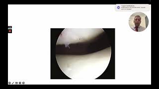 Knee Arthroscopy: A Basic Guide 👨‍⚕️