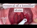 Removal of a tonsillar stone - patient education video by Dr. Carlo Oller