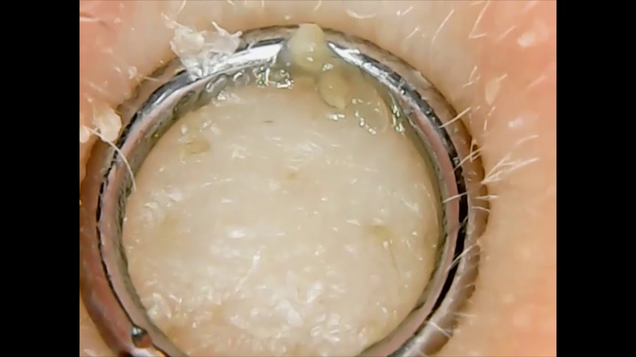 Comedone Extractions on Nose. An Educational Video! YouTube