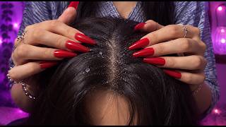🔥 Something Was Hiding in Her Scalp… 😳 | ASMR Hair & Scalp Treatment