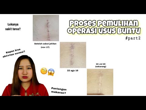 Video: Apa Yang Bisa Dan Tidak Bisa Dilakukan Setelah Operasi Usus Buntu? 7 Pertanyaan Kritis