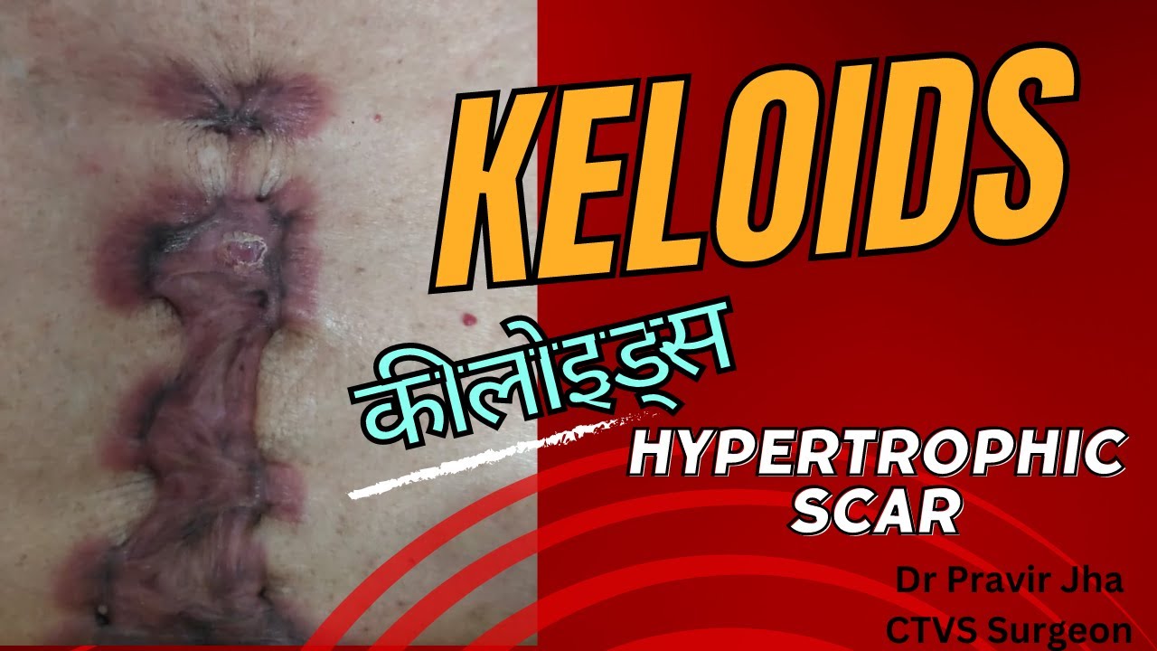 कीलोइड्  के कारण,  बचाव और उपचार | Causes, prevention and treatment of keloid | Dr.Pravir Jha