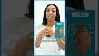 Incredible #bbl by incredible Dr. Luster! l Avana Plastic Surgery