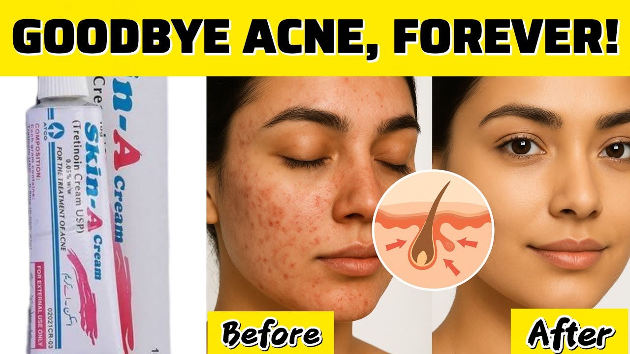 Face Acne: Why It Happens & How to End It for Good (Doctor-Based Guide)