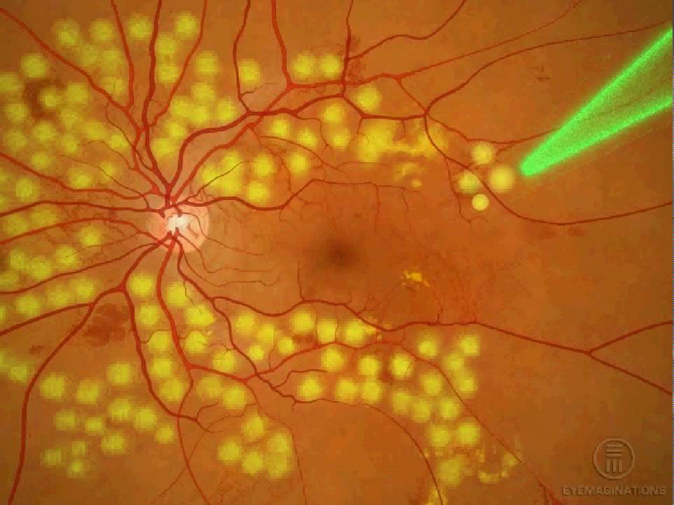 Глаз после лазерной коагуляции сетчатки. Диабетическая ретинопатия лазерная коагуляция. Периферическая лазеркоагуляция сетчатки. Лазерная фотокоагуляция сетчатки. Транспупиллярная лазеркоагуляция.