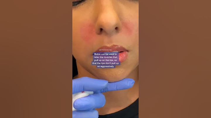Gummy Smile Correction with #Botox