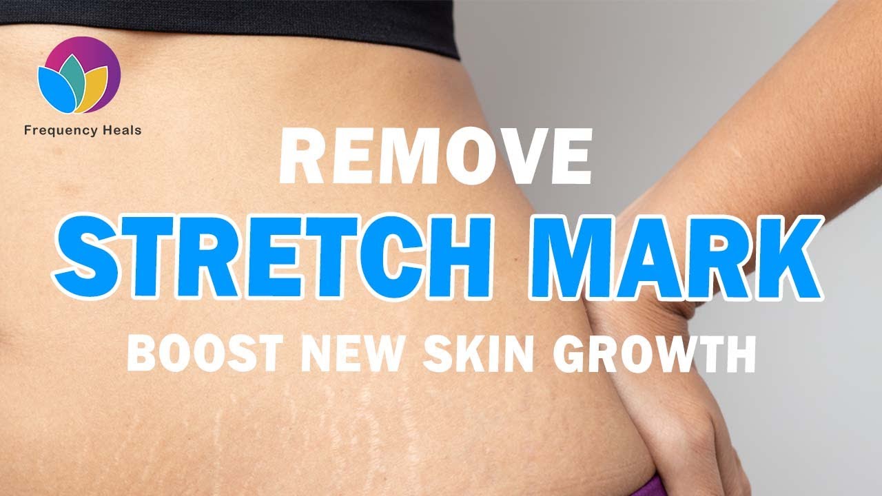 Stretch Mark Removal ★ Remove Dead Cells & Boost New Skin Growth ★ Flatten Your Skin