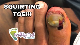 SQUIRTING TOE! ENTIRE NAIL REMOVED WITH SURPRISE UNDERNEATH!