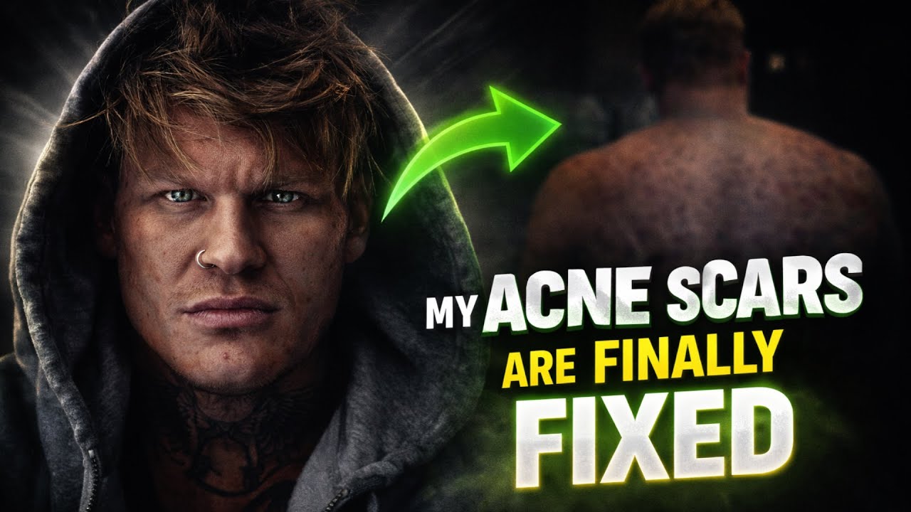 Как я навсегда избавилась от шрамов от акне