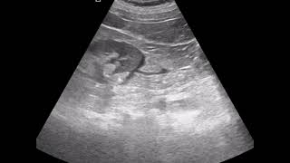 CASE 971 Double Line Sign in perirenal fat pad