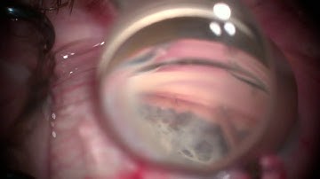 Kahook Dual-Blade Goniotomy | Brooks Eye Associates
