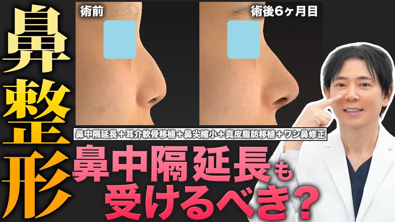Rhinoplasty] Should nasal septum extension be combined with nose