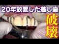 【前歯のブリッジ交換】20年間放置した差し歯をついにぶっ壊す！そして仮歯の装着へ…【ブリッジ・差し歯】