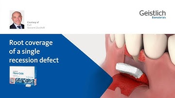 Prof. Giovanni Zucchelli: Root Coverage of a single recession defect